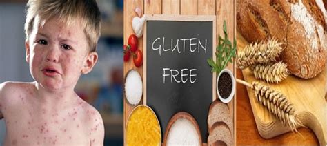 Gluten Alerjisi ve Alternatif Beslenme